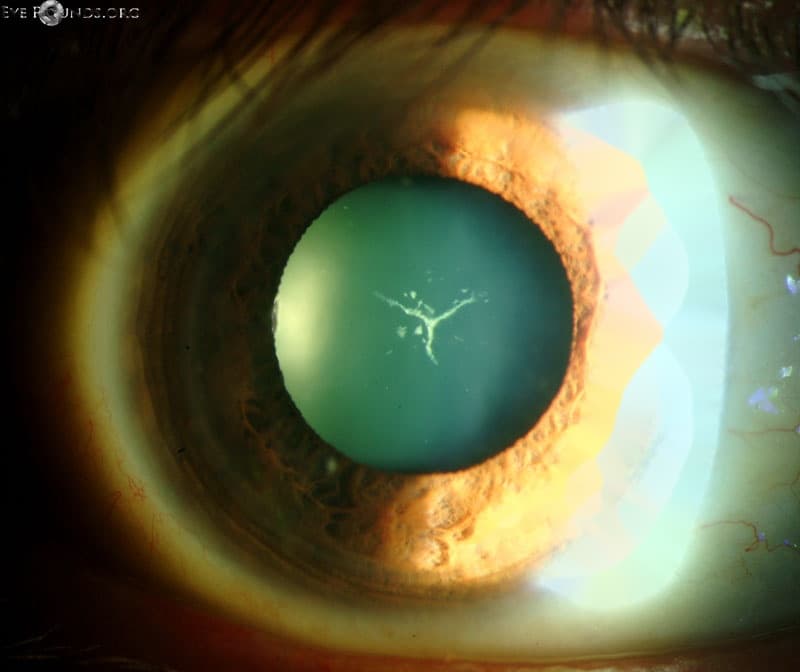 Clinical ophthalmic photograph of "y suture" cataract - cataract condition