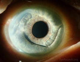 Clinical ophthalmic photograph of anterior chamber intraocular lens aciol implant - cataract condition