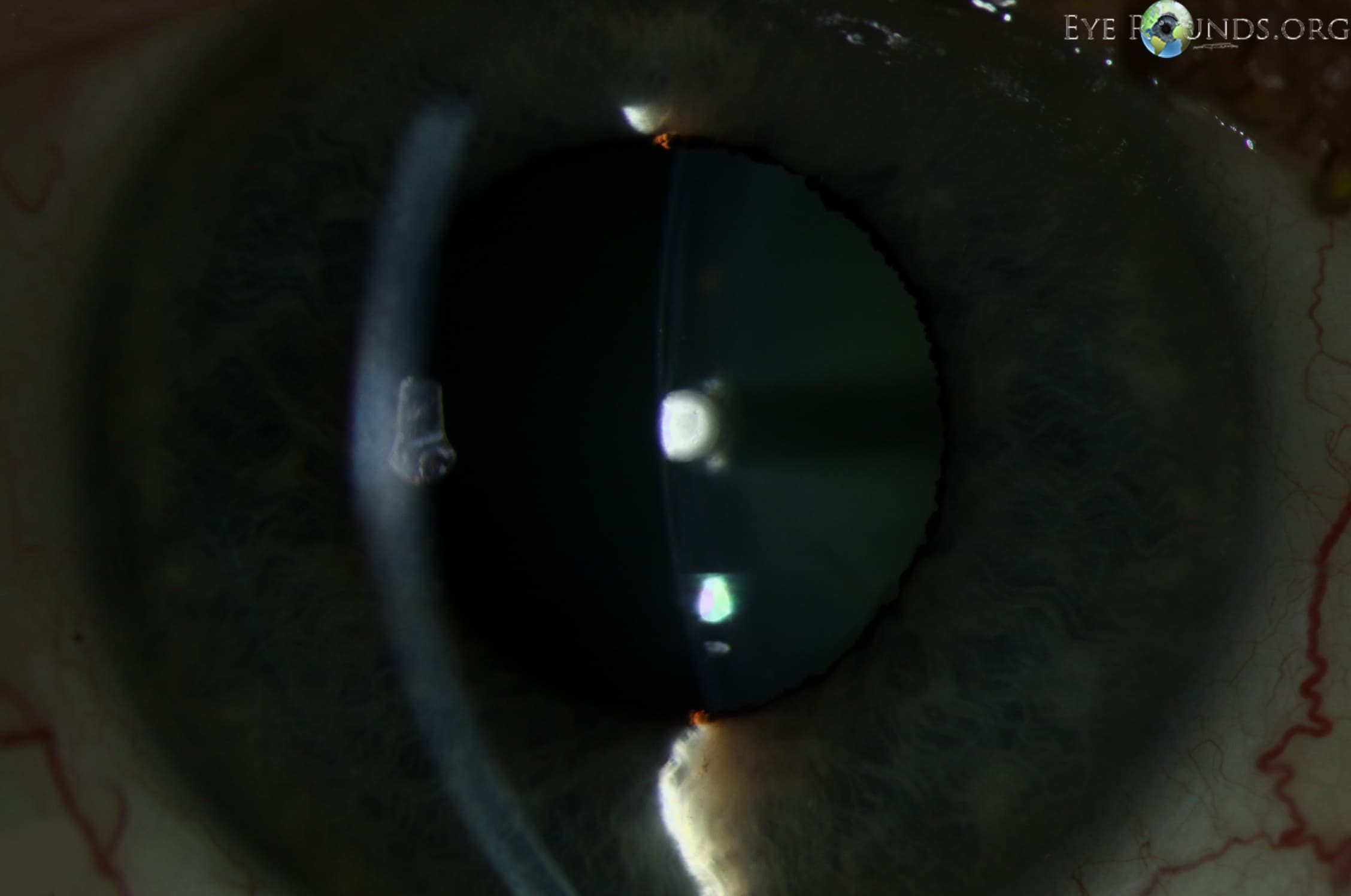 Clinical ophthalmic photograph of anterior polar cataract - cataract condition