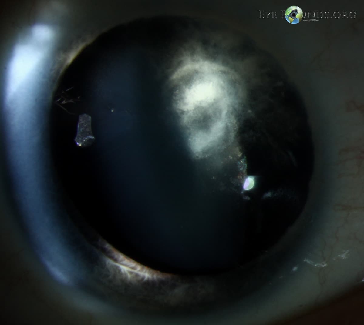 Clinical ophthalmic photograph of bilateral posterior polar cataracts - cataract condition