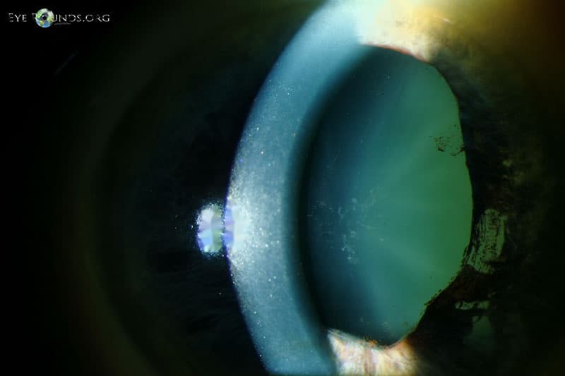 Clinical ophthalmic photograph of glaukomflecken and iris atrophy after acute angle closure glaucoma - cataract condition