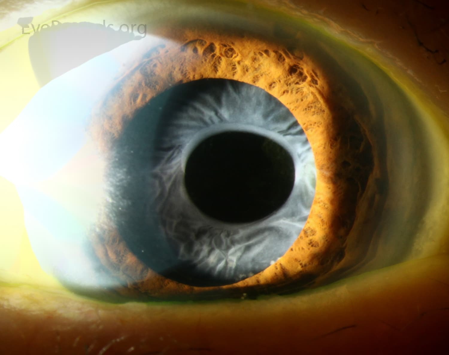 Clinical ophthalmic photograph of anterior capsular phimosis - contact lens condition