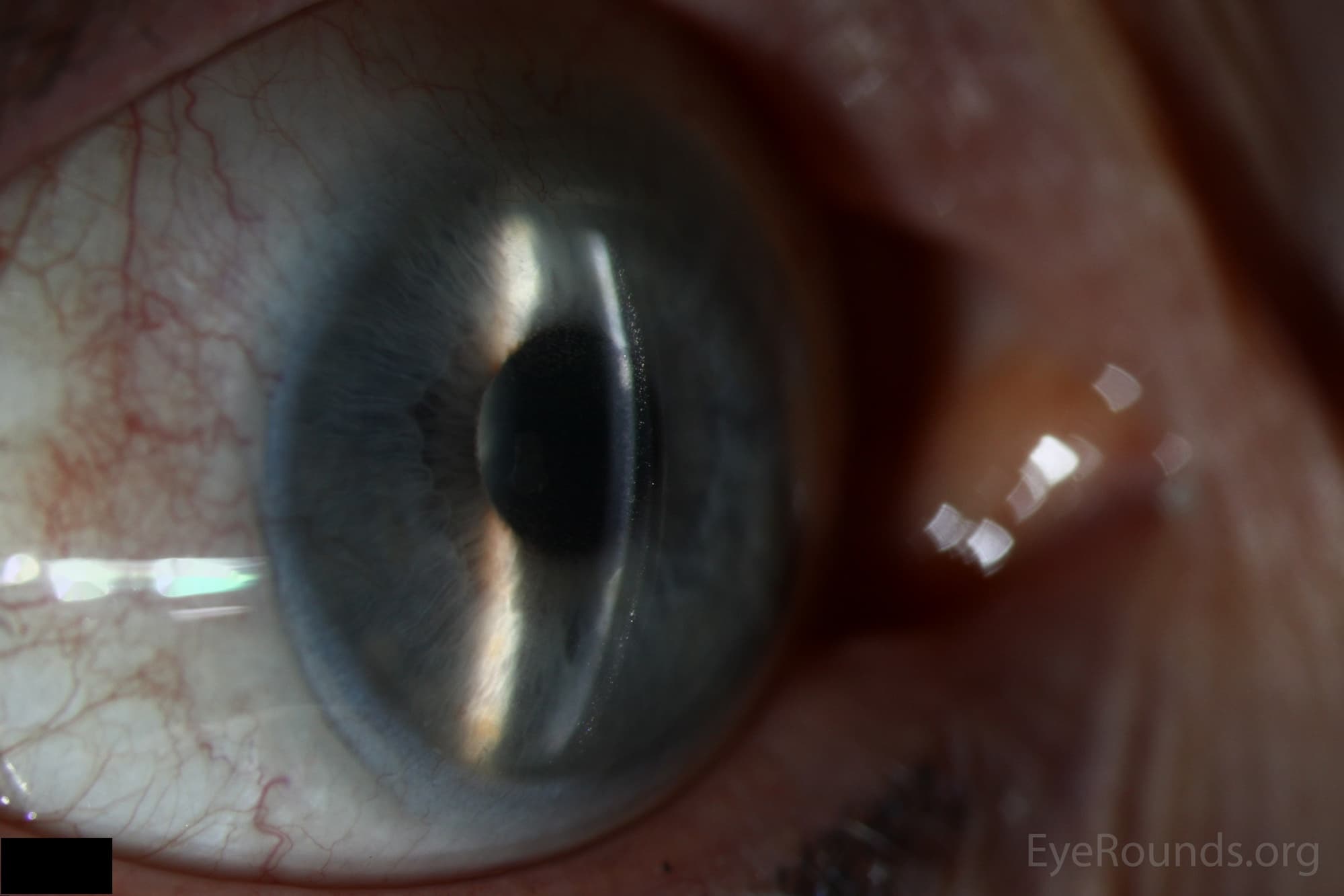 Clinical ophthalmic photograph of appropriate scleral lens sagittal depth - contact lens condition