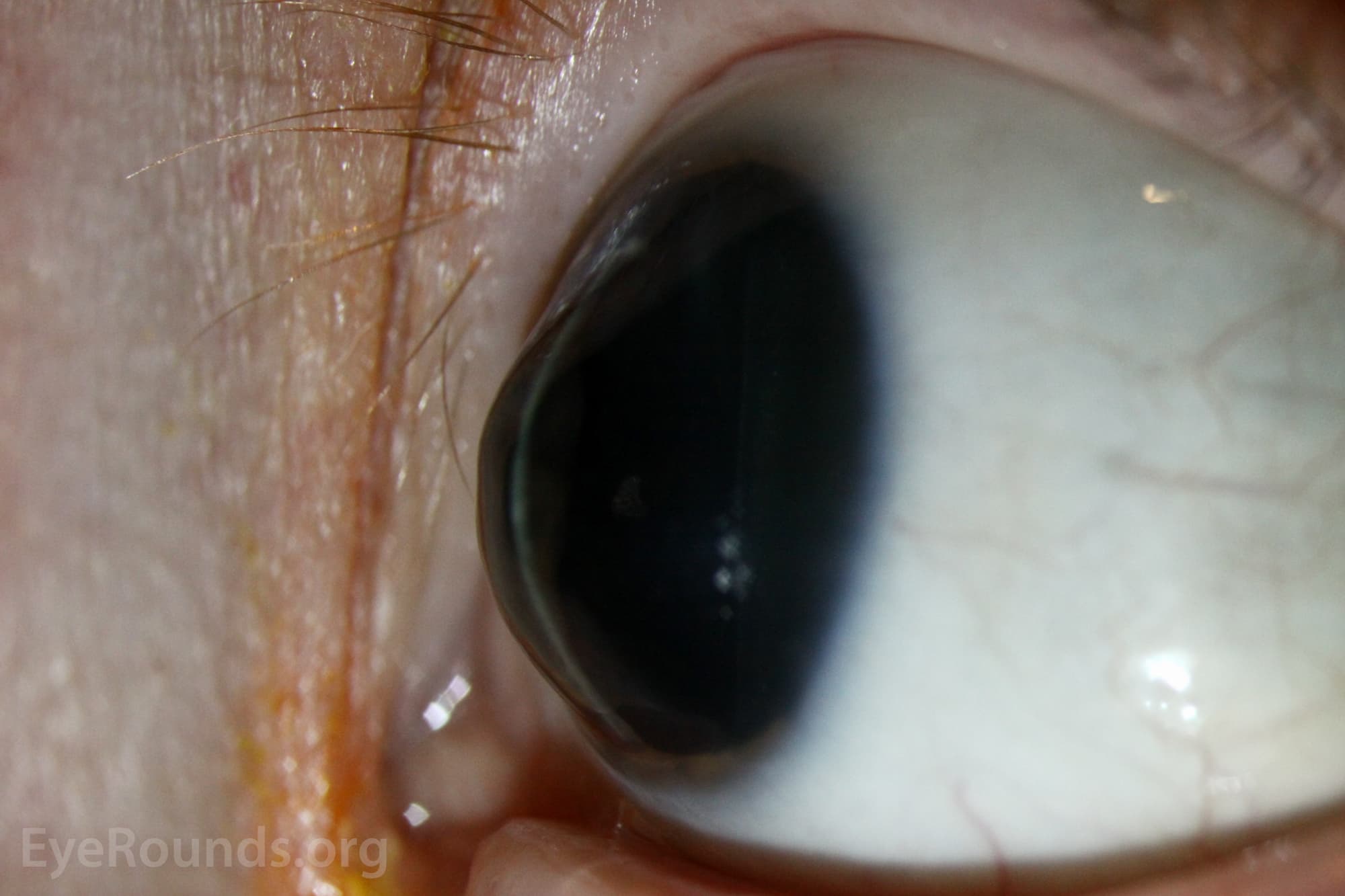 Clinical ophthalmic photograph of keratoconus - cornea condition