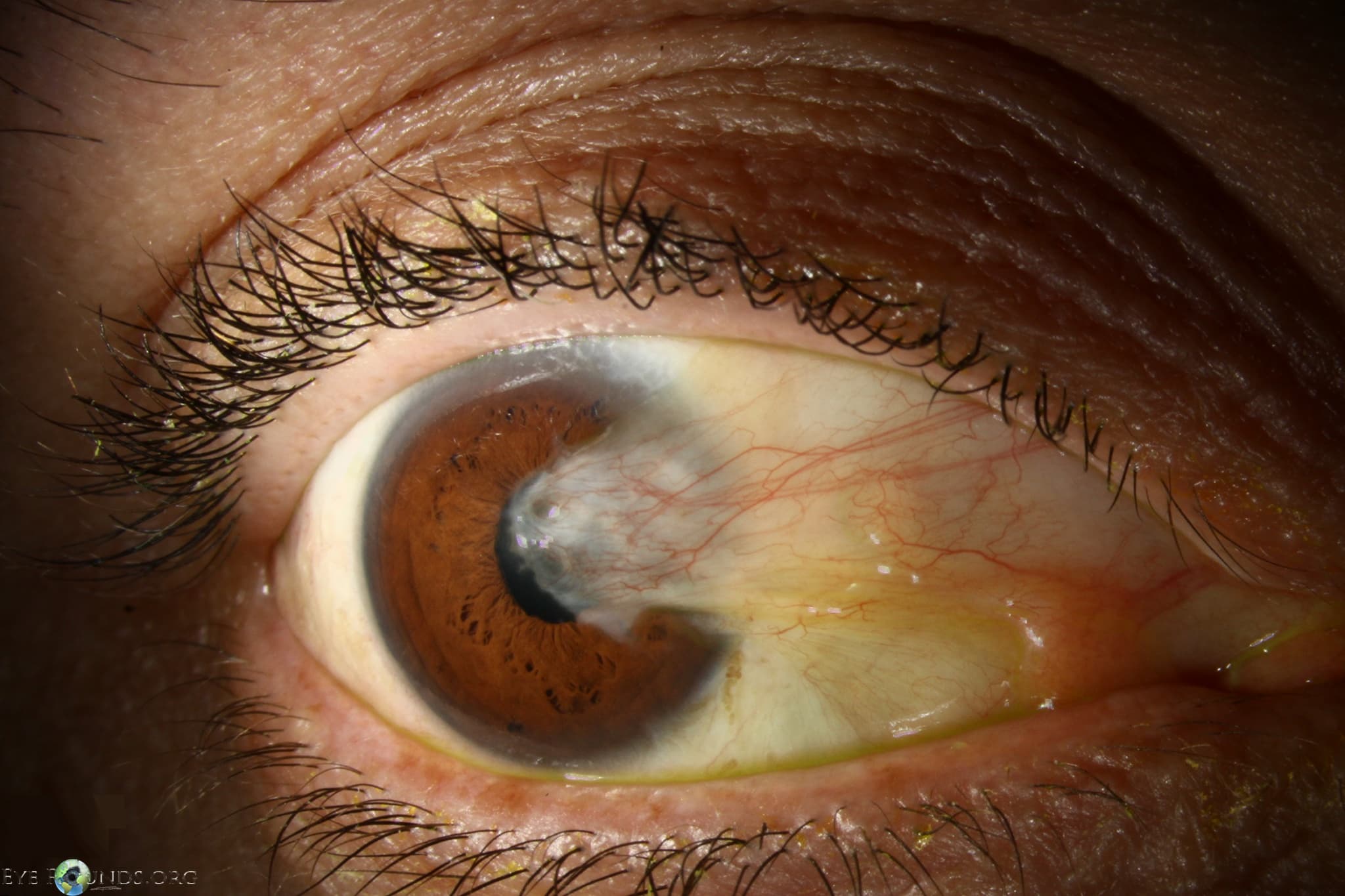 Clinical ophthalmic photograph of pterygium - cornea condition