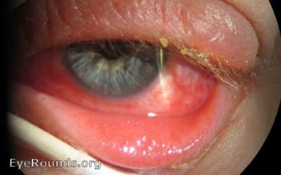 Clinical ophthalmic photograph of adenoviral conjunctivitis - external disease condition