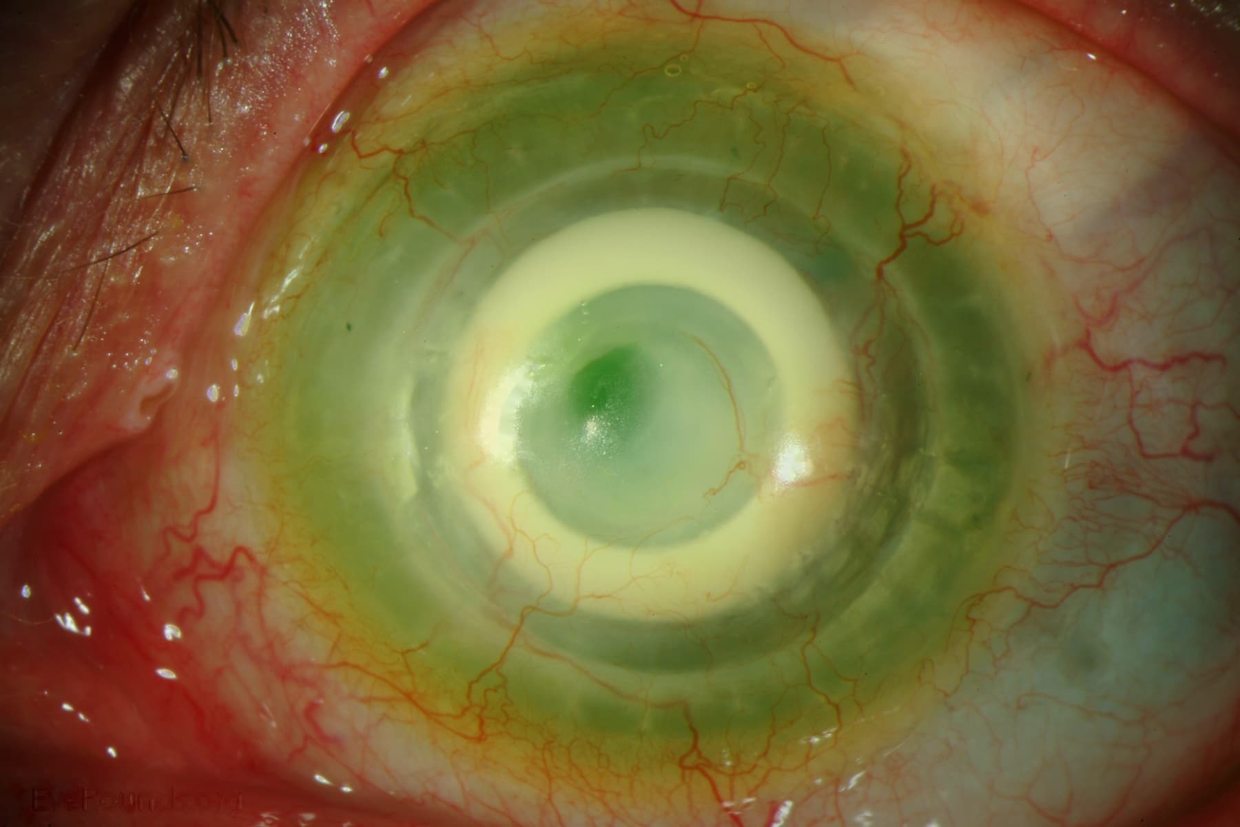 Clinical ophthalmic photograph of alphacor keratoprosthesis - external disease condition