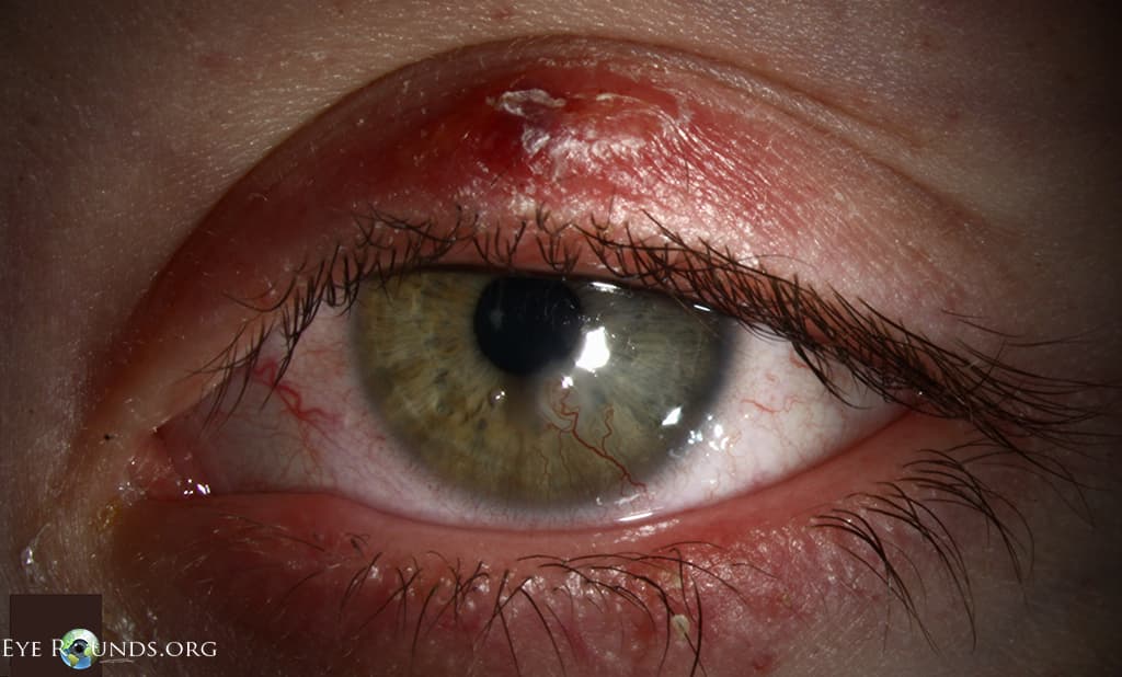 Clinical ophthalmic photograph of angioid blepharokeratoconjunctivitis of childhood - external disease condition