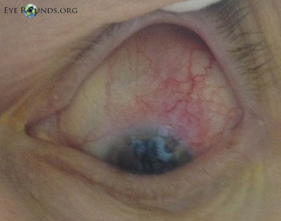 Clinical ophthalmic photograph of anterior scleritis - external disease condition