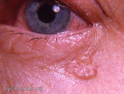 Clinical ophthalmic photograph of basal cell carcinoma - external disease condition