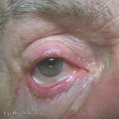 Clinical ophthalmic photograph of blepharitis and meibomian gland dysfunction - external disease condition