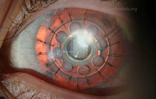 Clinical ophthalmic photograph of boston keratoprosthesis kpro for congenital aniridia - external disease condition