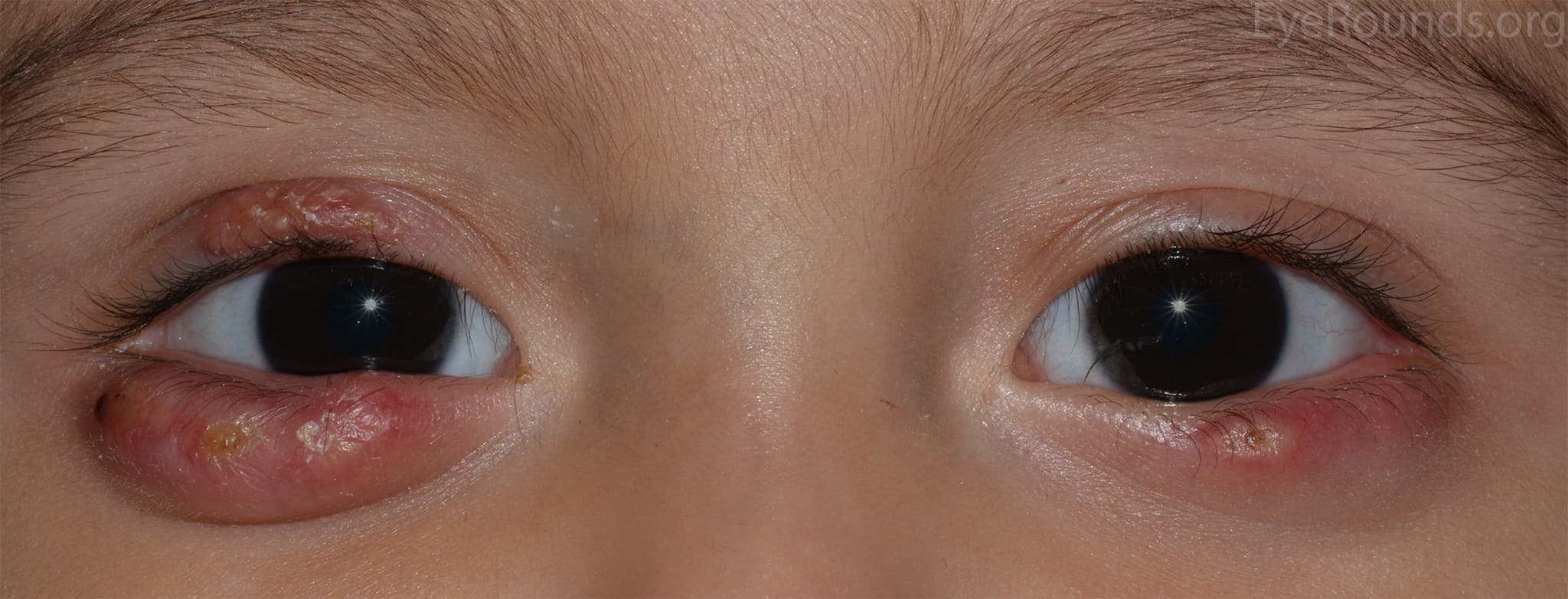 Clinical ophthalmic photograph of chalazia - external disease condition
