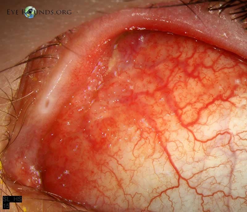 Clinical ophthalmic photograph of chlamydia trachomatis infection - external disease condition