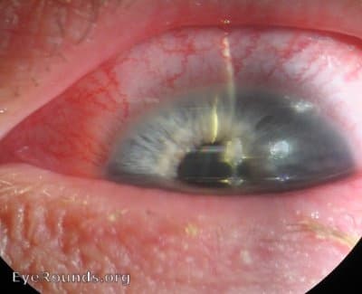 Clinical ophthalmic photograph of ciliary flush - external disease condition