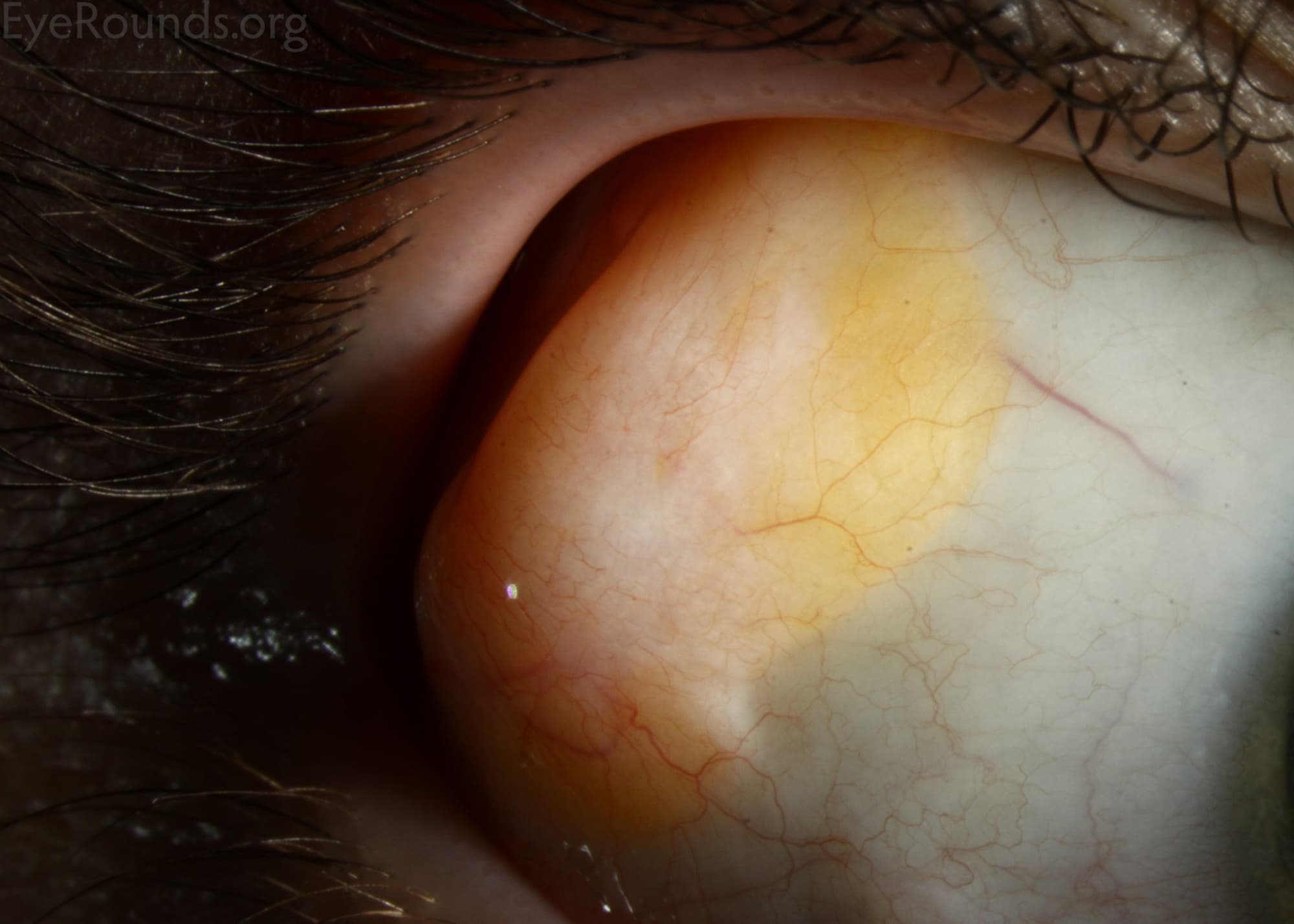 Clinical ophthalmic photograph of complex choristoma of the conjunctiva - external disease condition