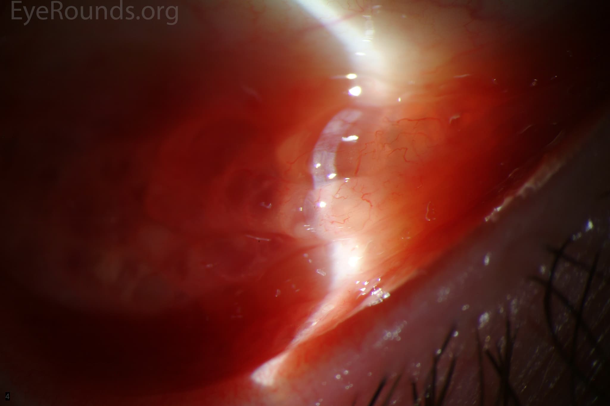 Clinical ophthalmic photograph of follicular conjunctivitis - external disease condition