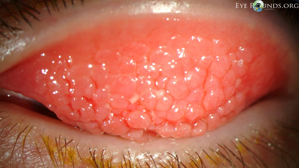 Clinical ophthalmic photograph of palpebral vernal keratoconjunctivitis vkc - external disease condition