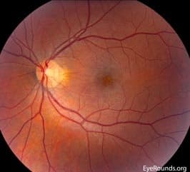 Clinical ophthalmic photograph of acute macular neuroretinopathy amn - genetics condition