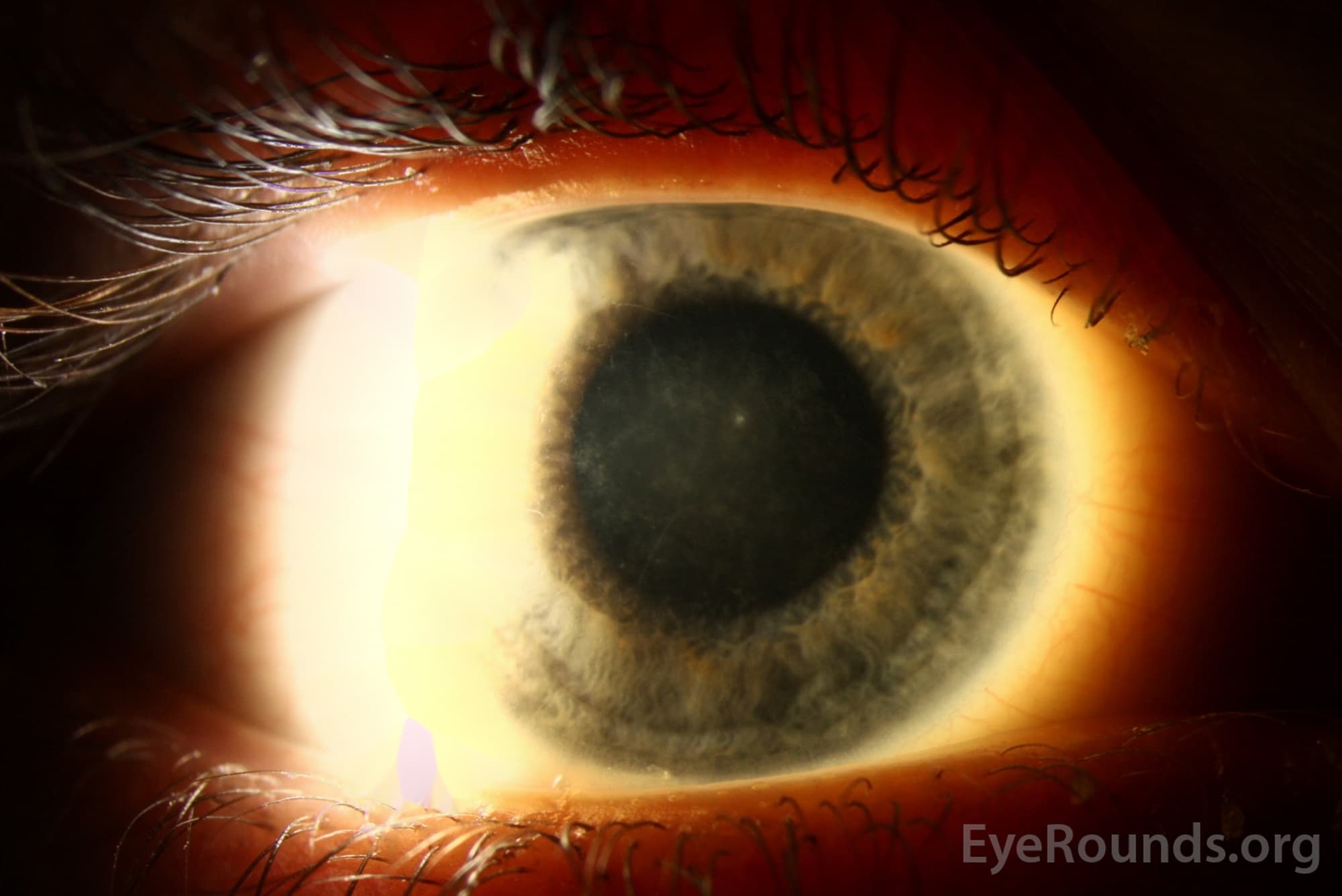 Clinical ophthalmic photograph of avellino dystrophy - genetics condition