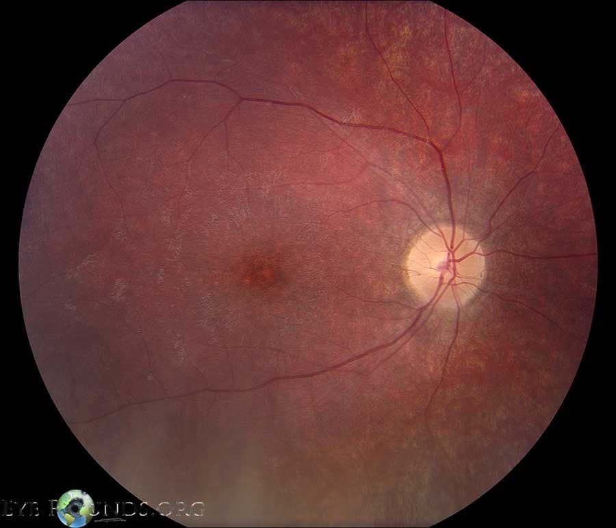 Clinical ophthalmic photograph of batten disease - genetics condition