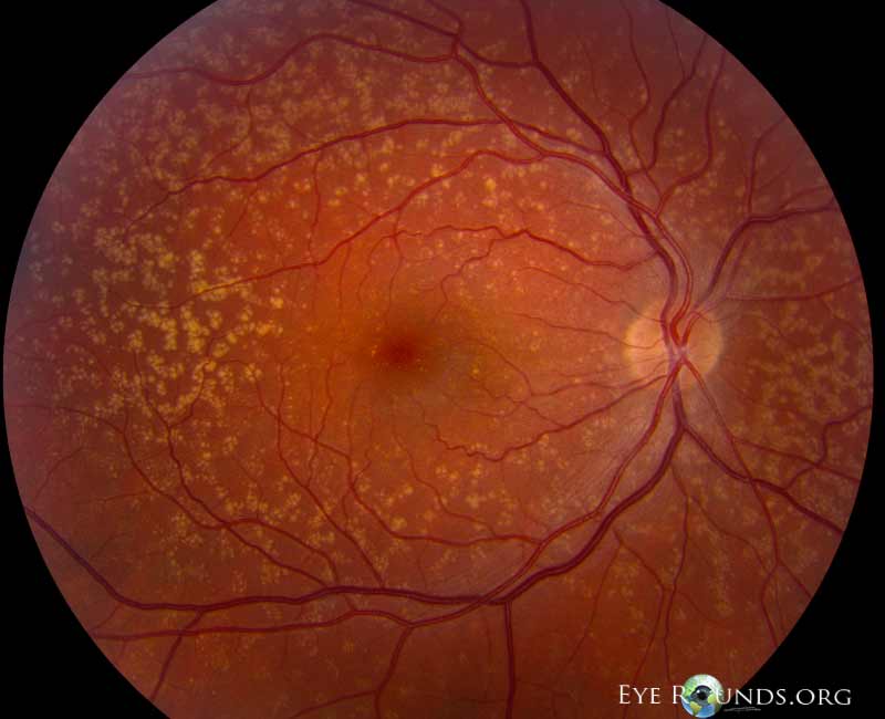 Clinical ophthalmic photograph of cuticular drusen - genetics condition