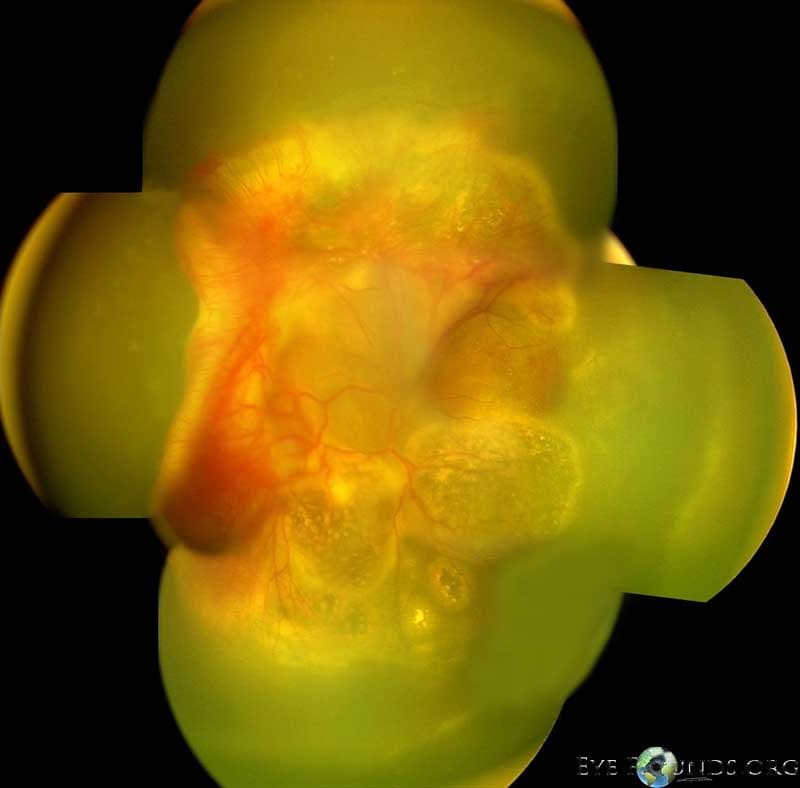 Clinical ophthalmic photograph of familial exudative vitreoretinopathy fevr1 - genetics condition