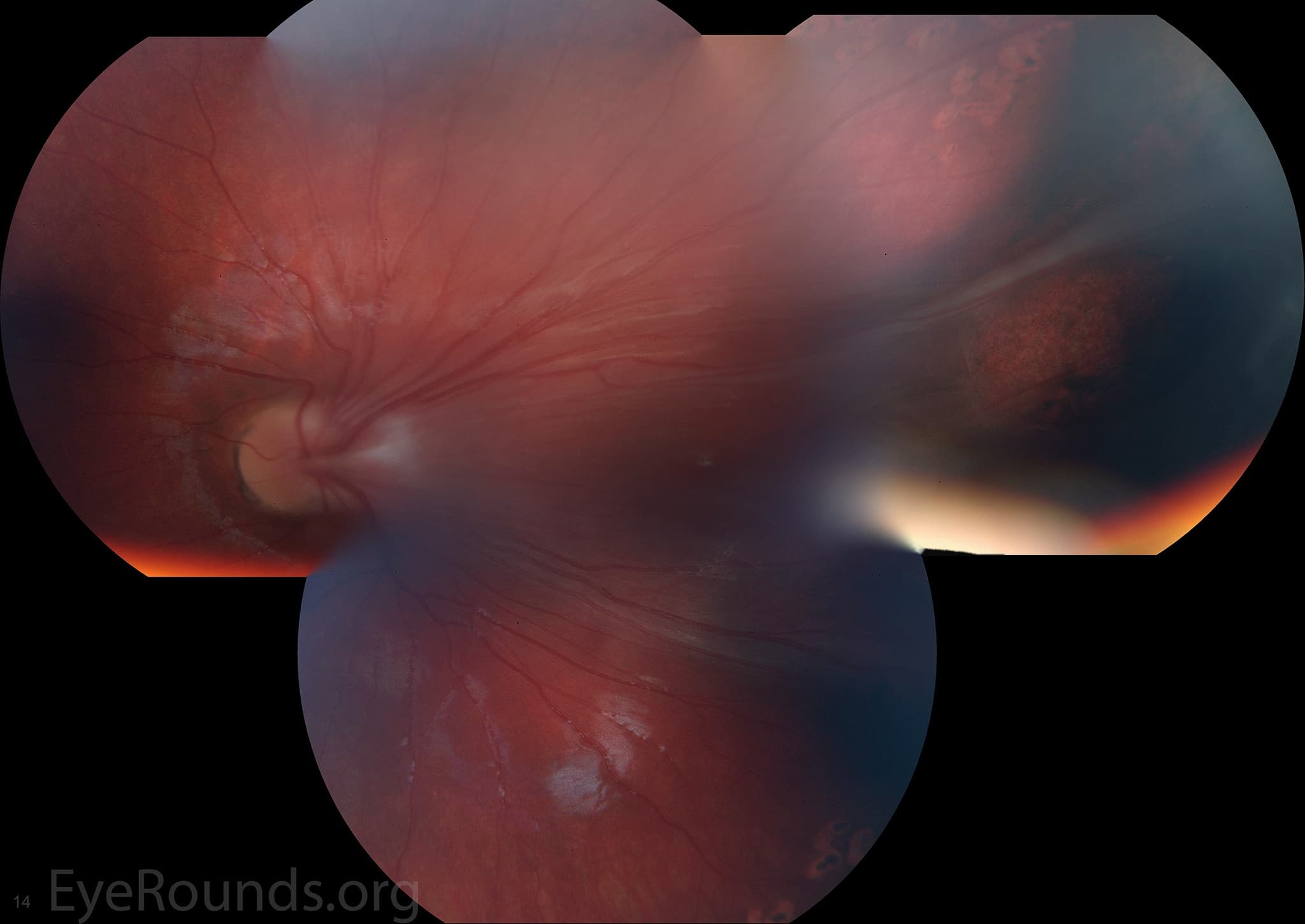 Clinical ophthalmic photograph of familial exudative vitreoretinopathy fevr2 - genetics condition