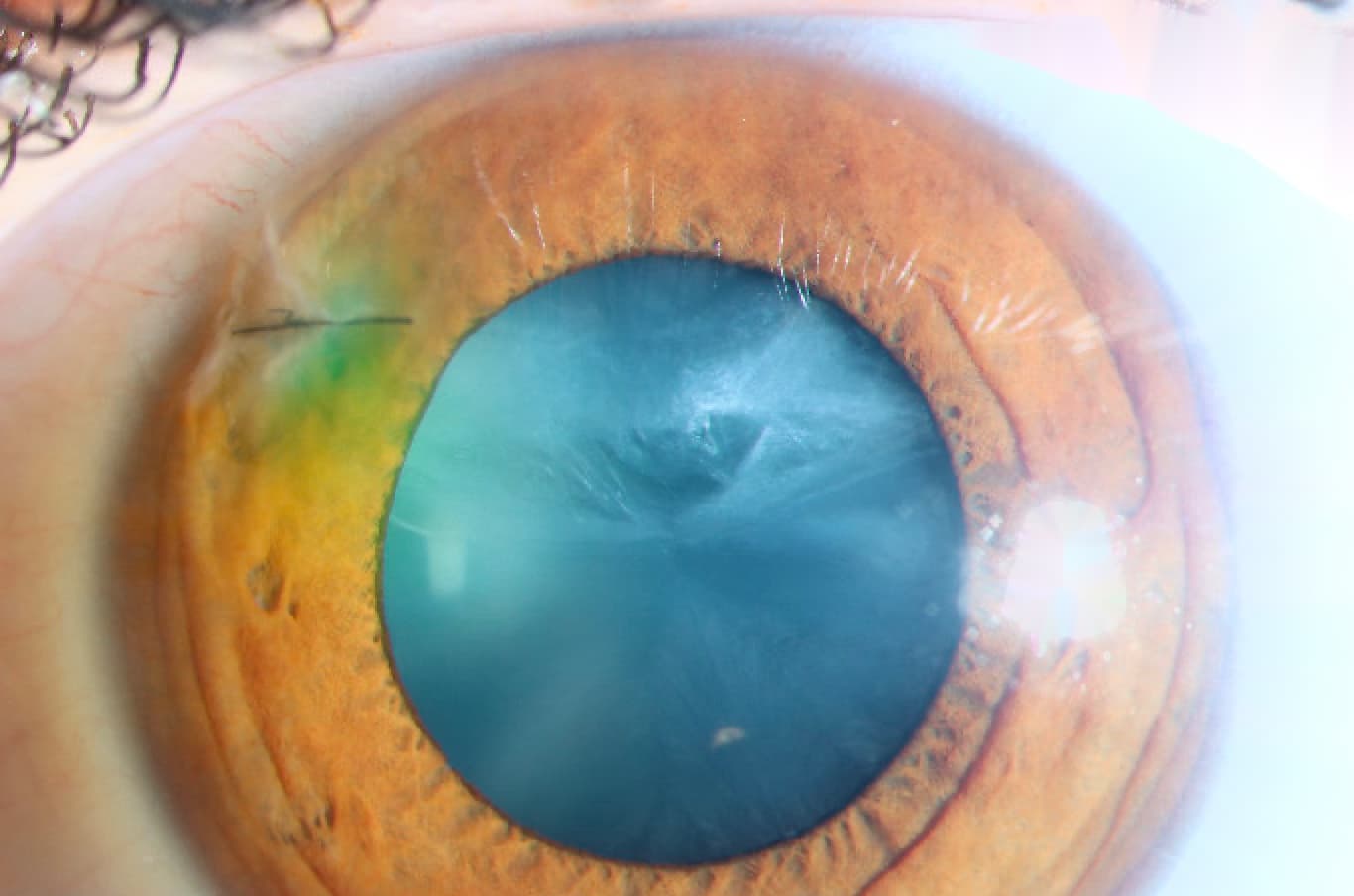 Clinical ophthalmic photograph of capsular violation - glaucoma condition