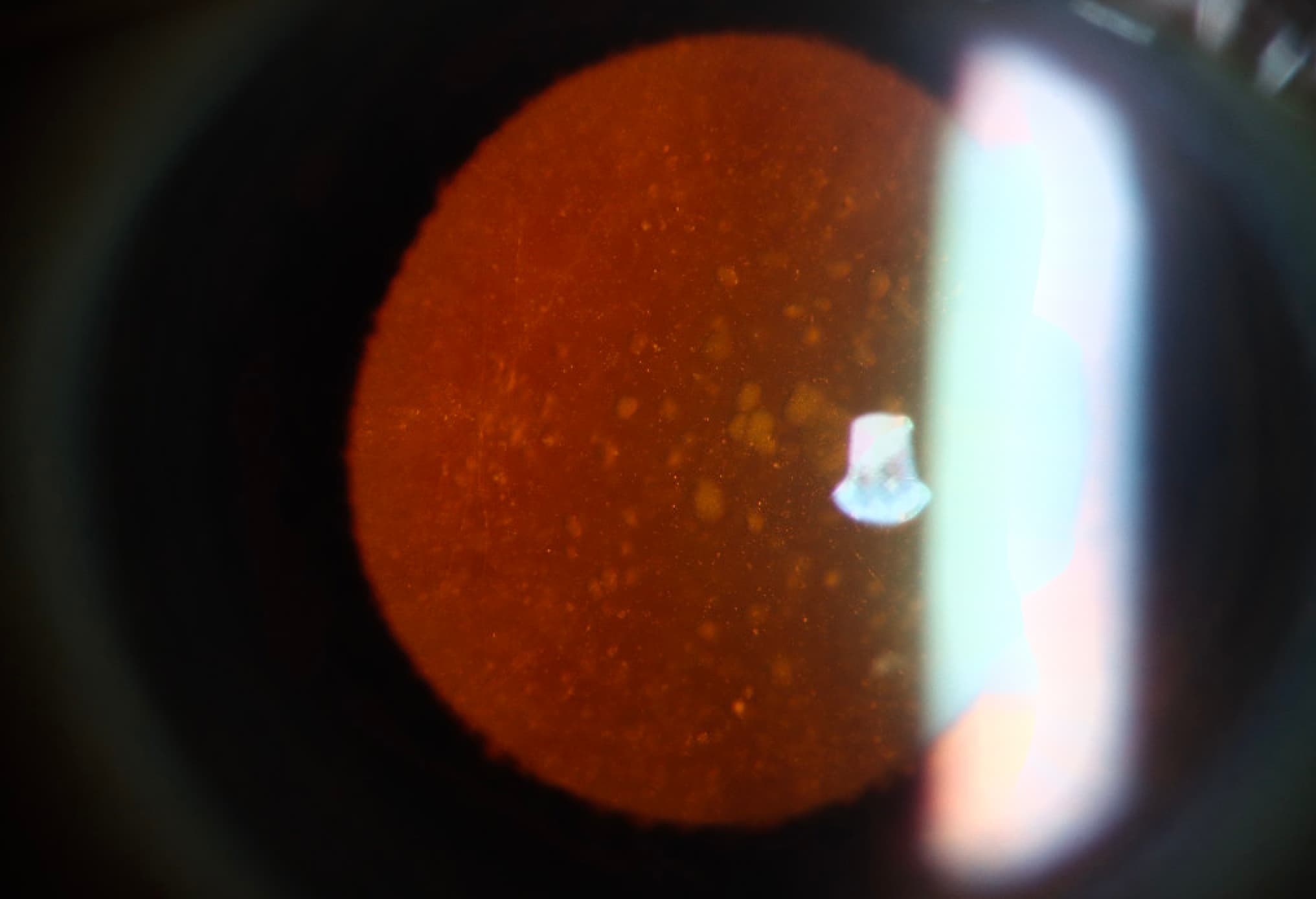Clinical ophthalmic photograph of cataract with cortical vacuoles - glaucoma condition