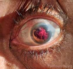 Clinical ophthalmic photograph of hyphema following aborted istent procedure - glaucoma condition