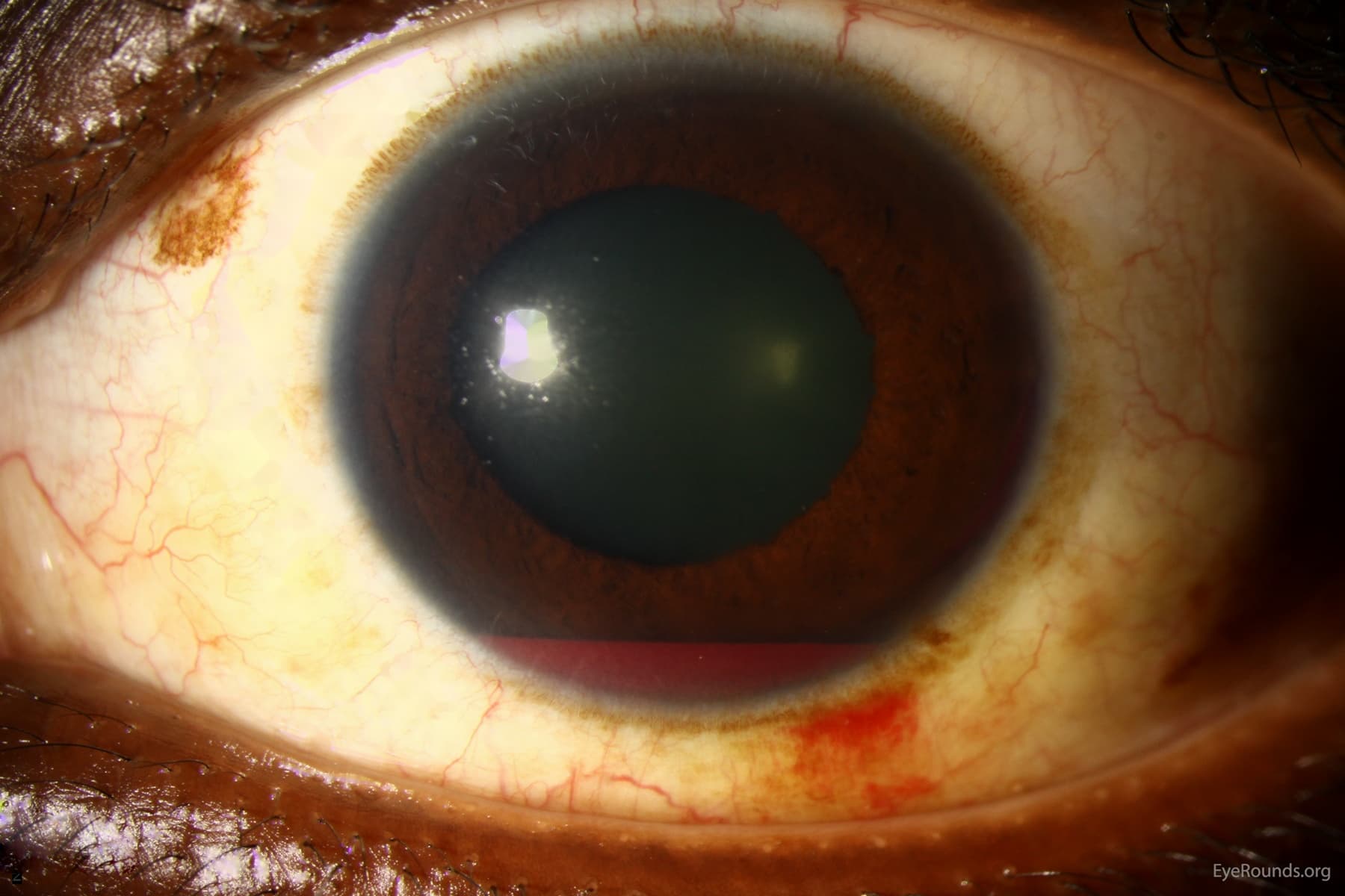 Clinical ophthalmic photograph of hyphema - glaucoma condition