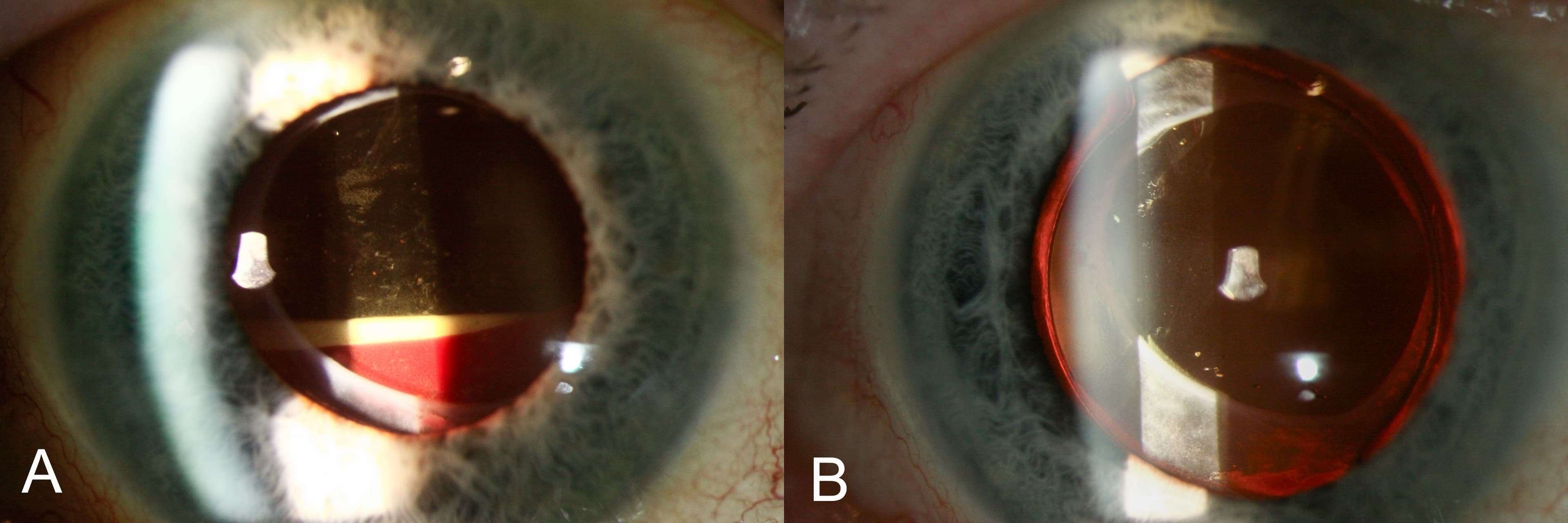 Clinical ophthalmic photograph of layered intracapsular hemorrhage following phacoemulsification gatt - glaucoma condition