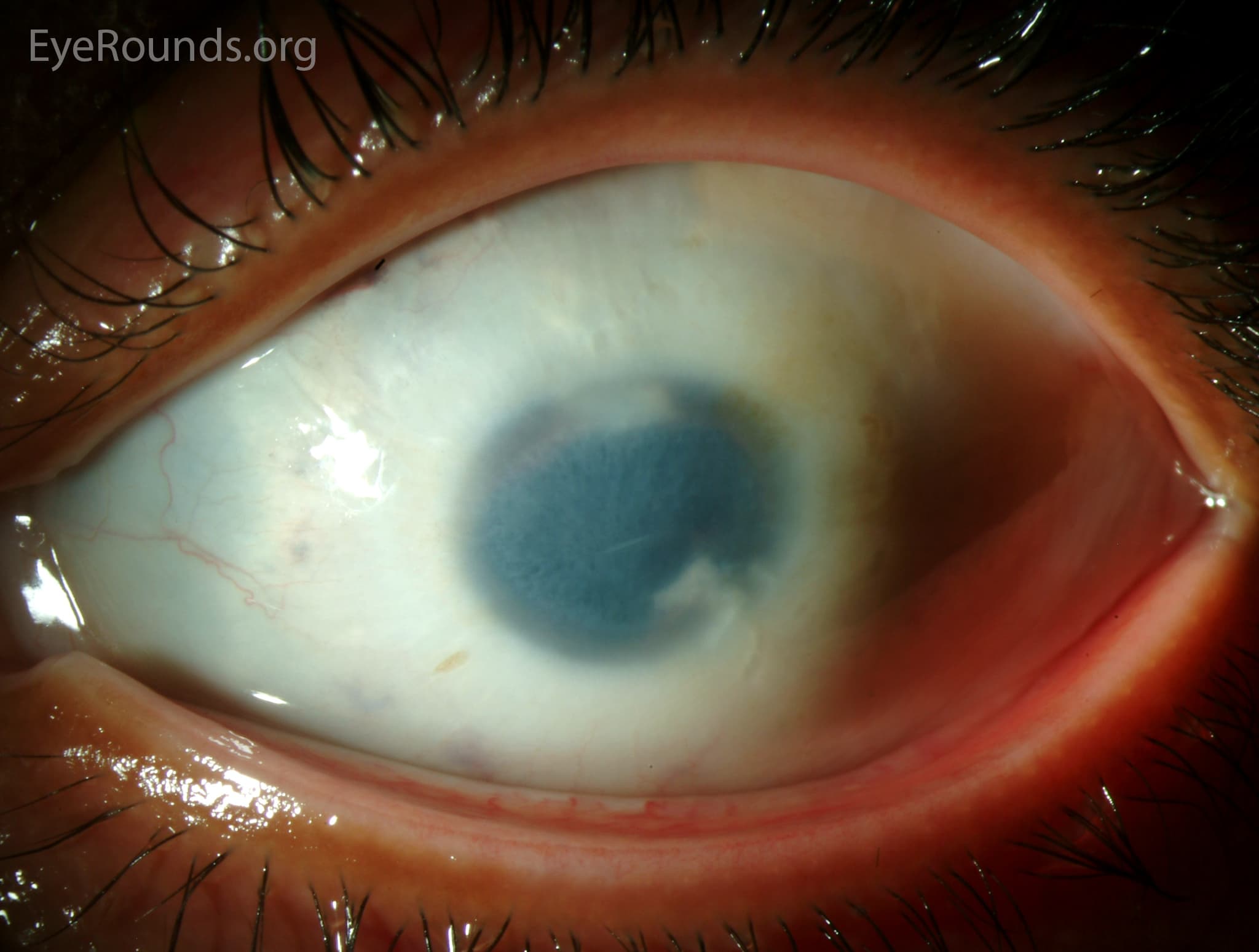 Clinical ophthalmic photograph of microcornea - glaucoma condition