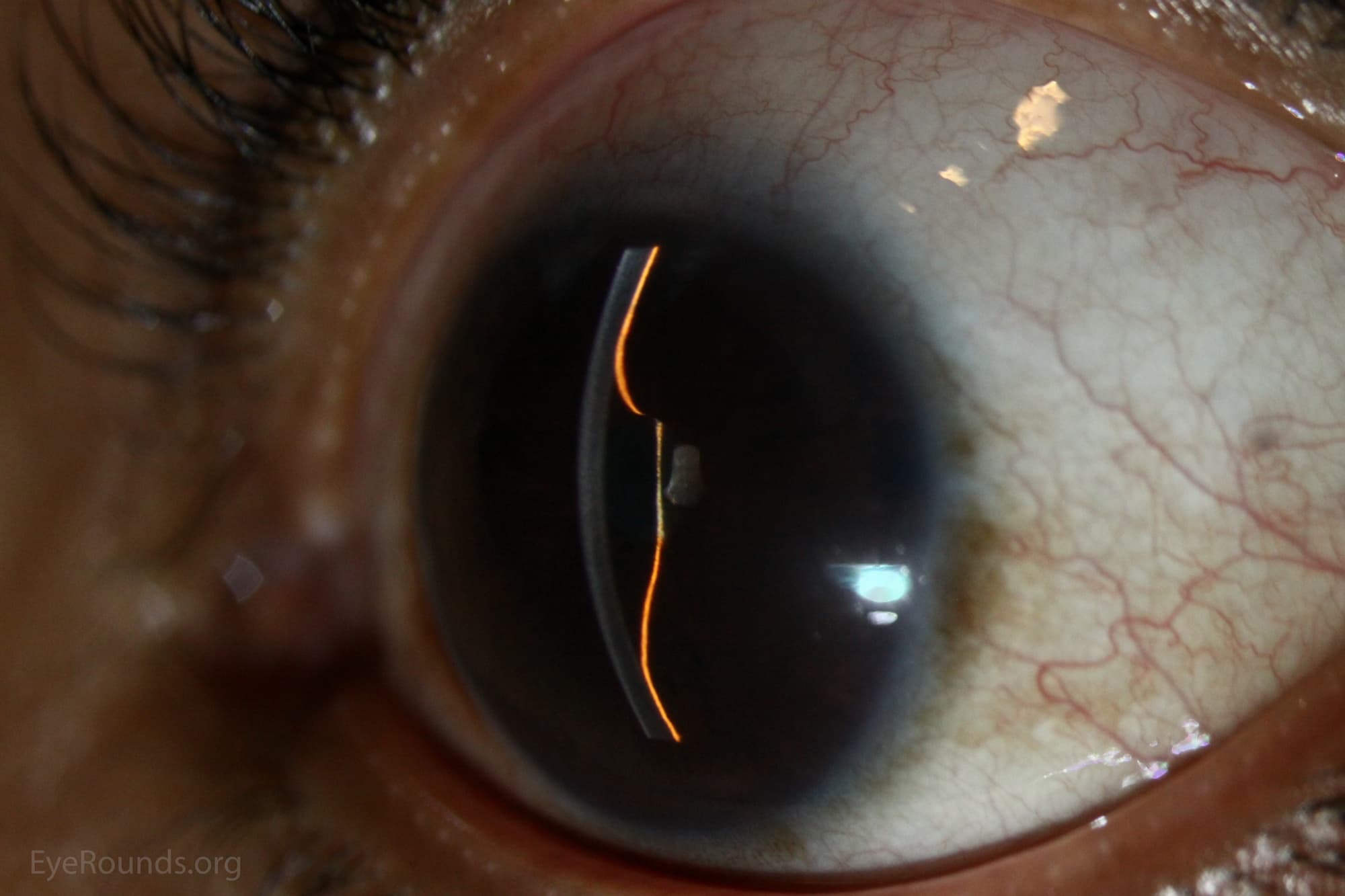 Clinical ophthalmic photograph of iris bombe - iris condition