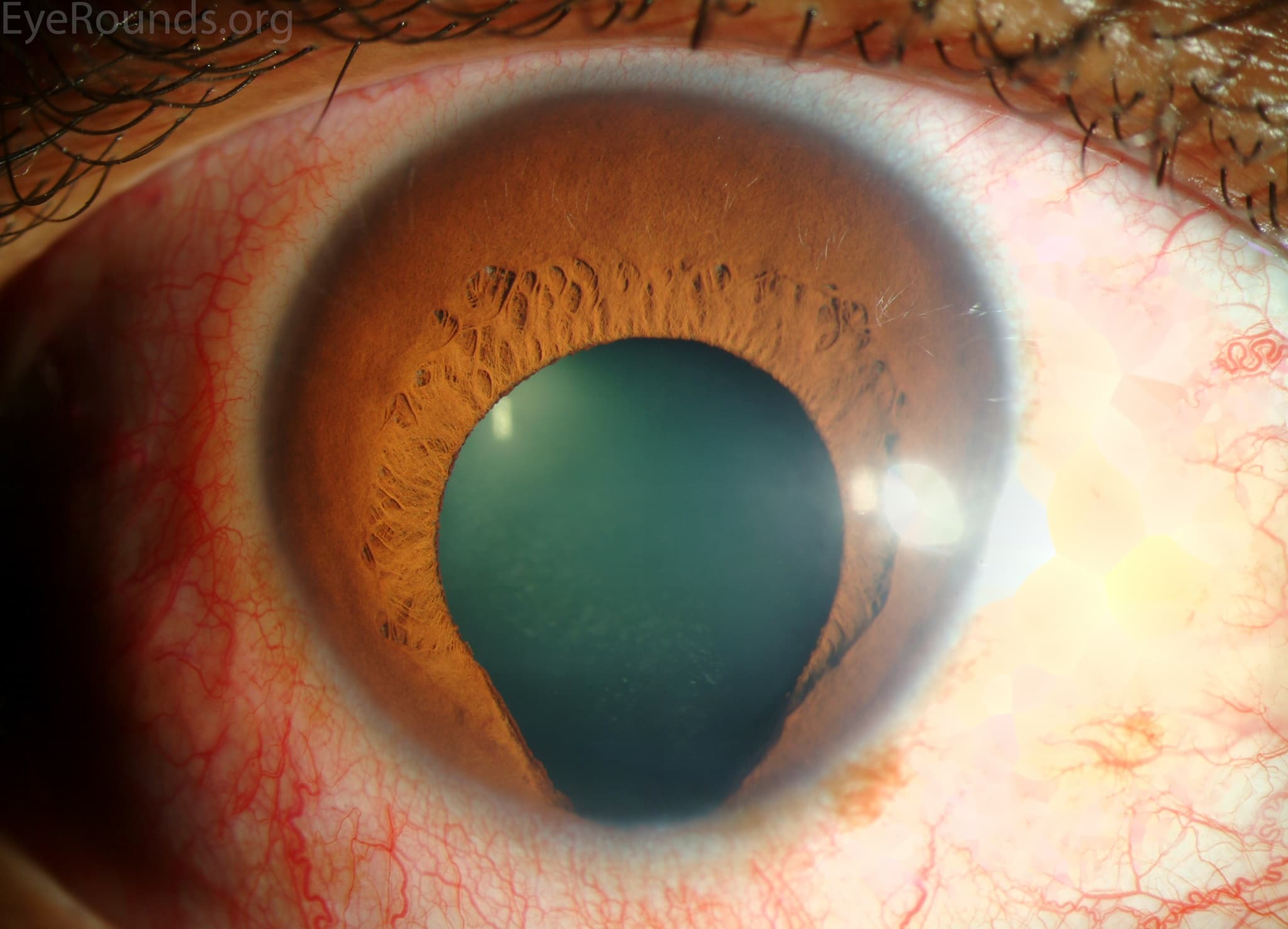 Clinical ophthalmic photograph of iris coloboma - iris condition