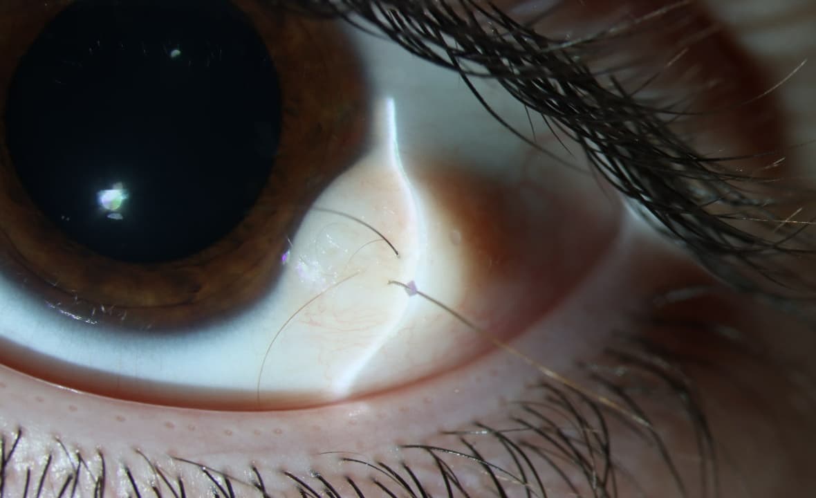 Clinical ophthalmic photograph of limbal dermoid - iris condition