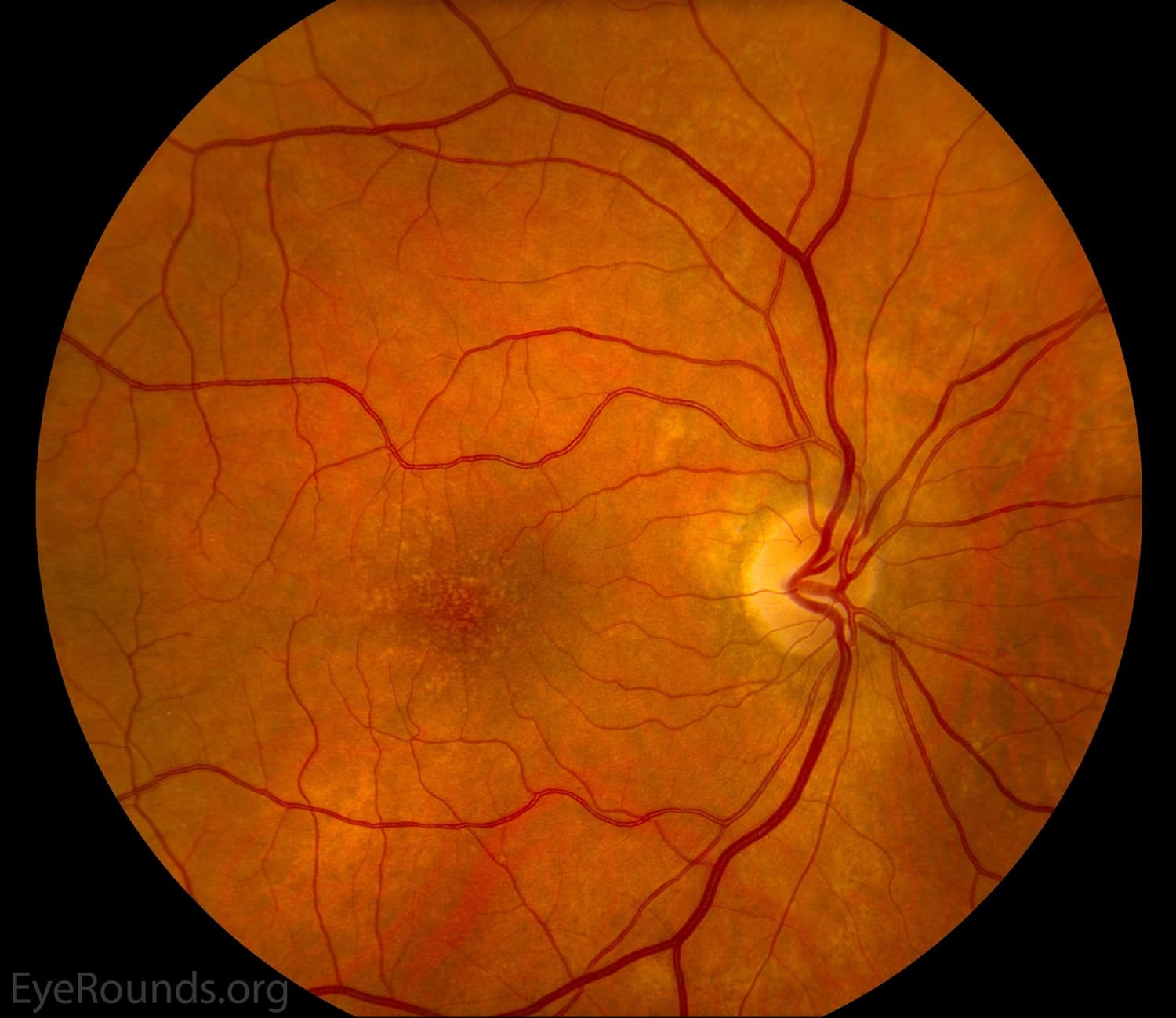 Clinical ophthalmic photograph of age related macular degeneration amd - retina condition