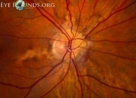 Clinical ophthalmic photograph of angioid streaks - retina condition