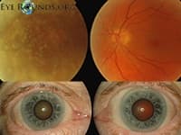 Clinical ophthalmic photograph of asteroid hyalosis - retina condition