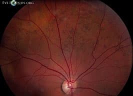 Clinical ophthalmic photograph of bear tracks - retina condition