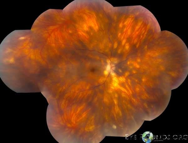 Clinical ophthalmic photograph of birdshot chorioretinopathy - retina condition