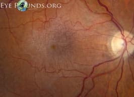 Clinical ophthalmic photograph of epiretinal membrane erm - retina condition