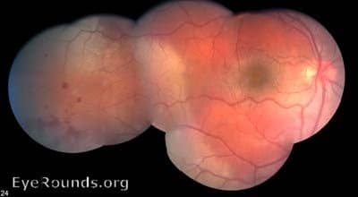 Clinical ophthalmic photograph of commotio retinae - trauma condition