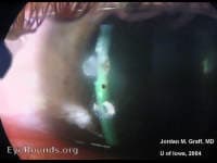 Clinical ophthalmic photograph of ferrous foreign body: rust ring - trauma condition