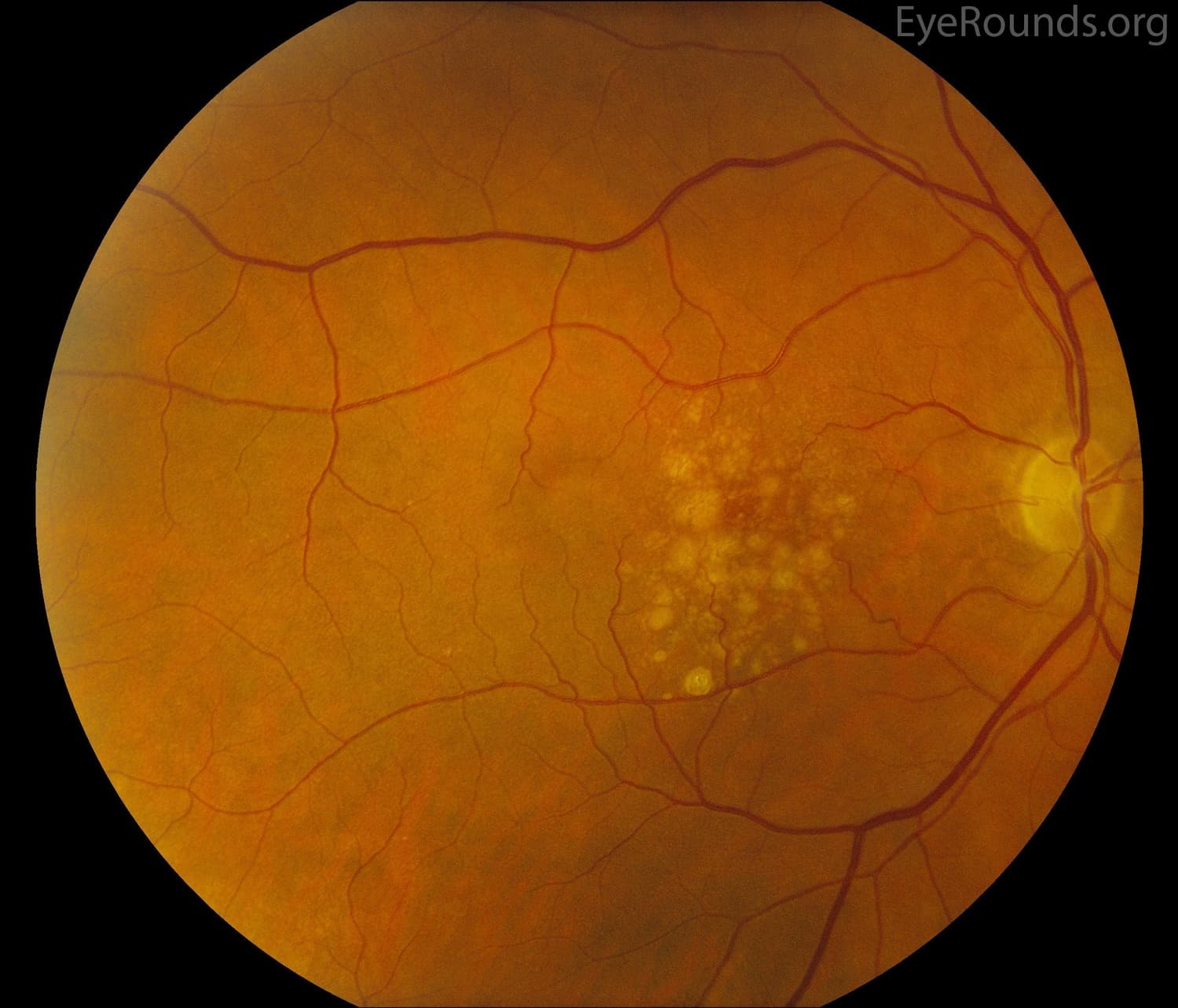 Clinical ophthalmic photograph of age related macular degeneration - vitreous condition