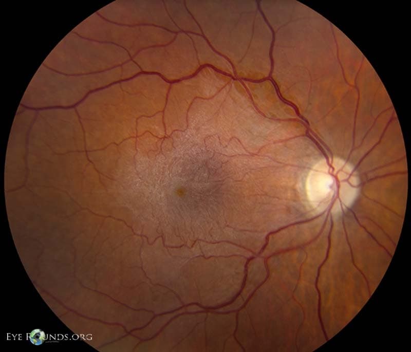Clinical ophthalmic photograph of epiretinal membrane - vitreous condition