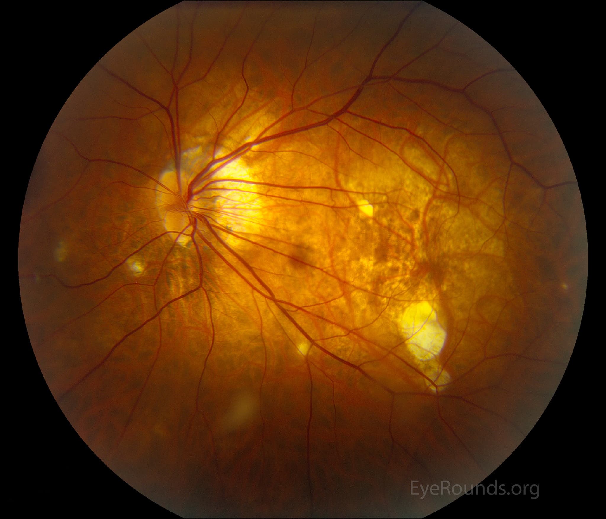 Clinical ophthalmic photograph of pathologic myopia with bilateral posterior staphylomas - vitreous condition