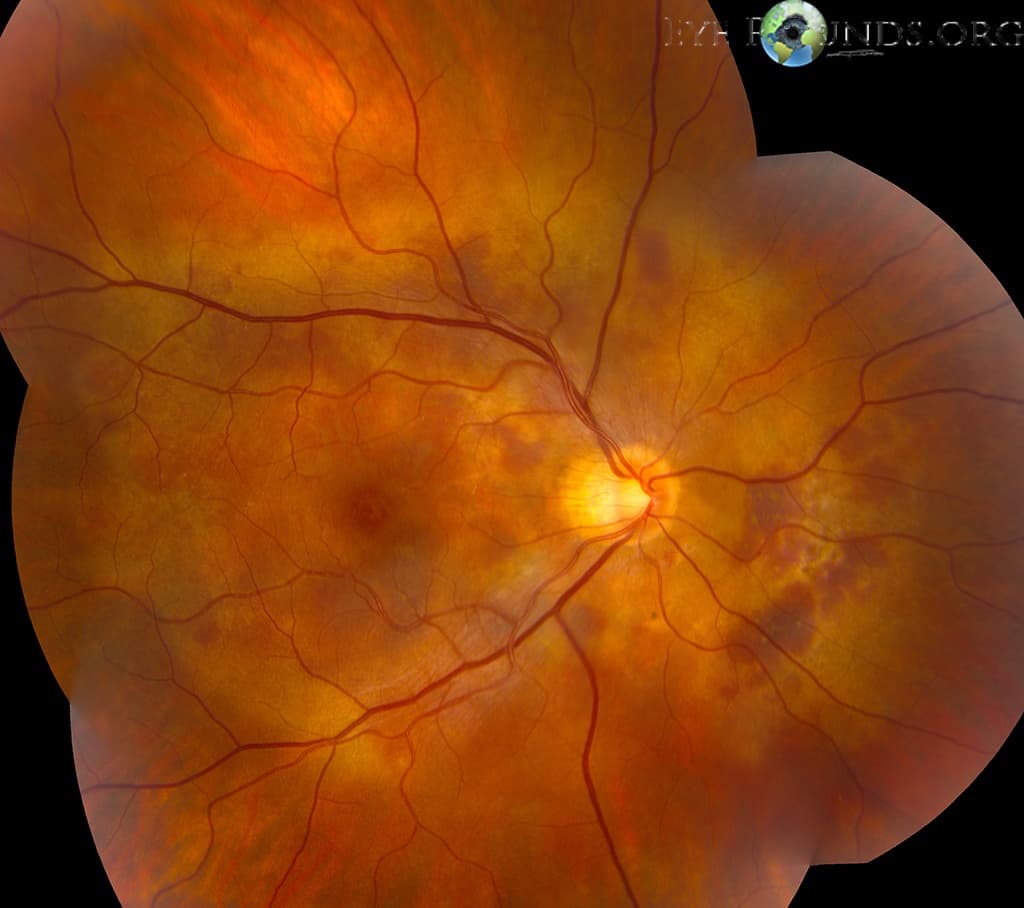 Clinical ophthalmic photograph of polypoidal choroidal vasculopathy pcv - vitreous condition