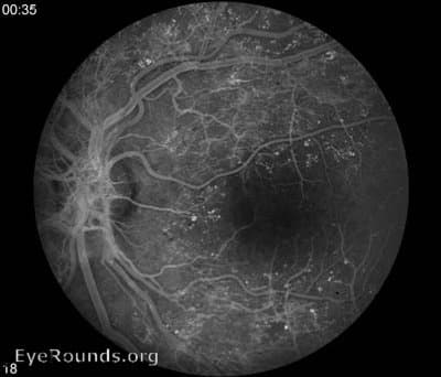 Clinical ophthalmic photograph of proliferative diabetic retinopathy pdr - vitreous condition